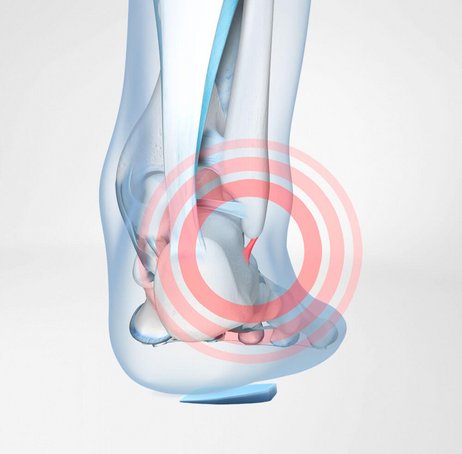 CaligaLoc® Immobilizzazione parziale della caviglia tallone BAUERFEIND